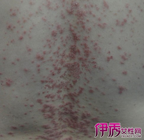 患子宫内膜异位症2年不怀孕，可以供卵做借卵试管吗？供卵做二代代生试管,供精试管,供卵做私立自怀试管知识