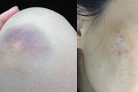 试管移植七天抽血能测出怀孕吗