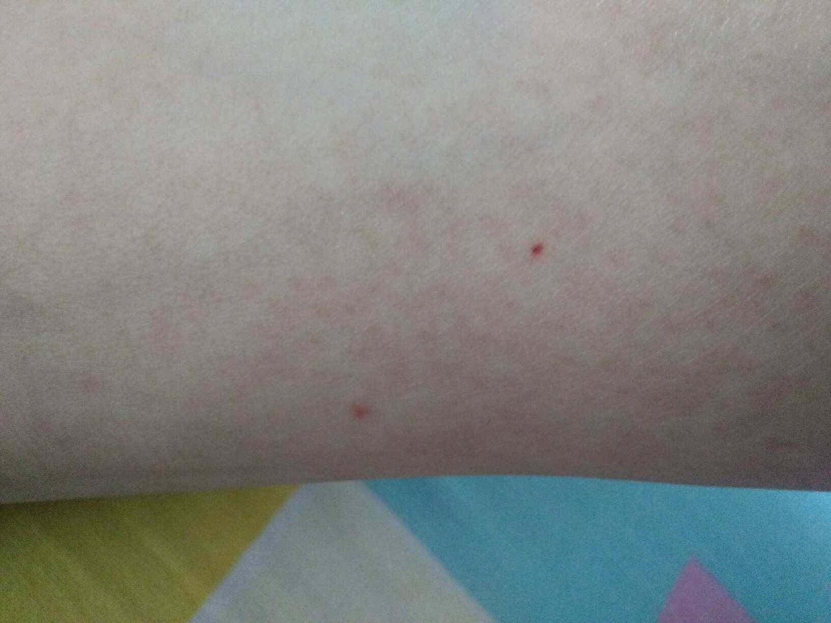 试管移植后第十天出血怎么回事？该怎么办呢？