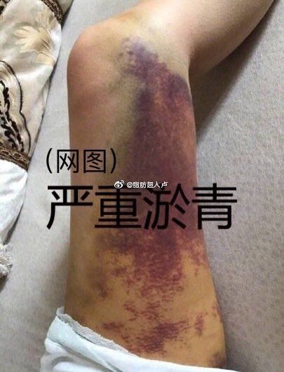 试管长方案和短方案哪种伤害小